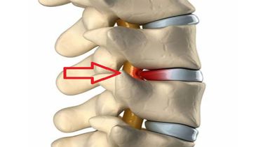 Κήλη μεσοσπονδύλιου δίσκου